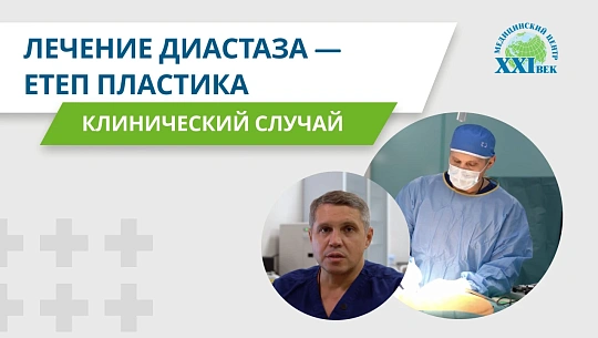 Лечение диастаза — ЕТЕП пластика